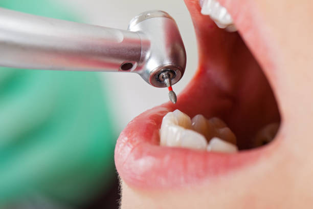 Best Emergency Tooth Extraction in Rutherford College, NC